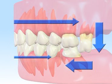 歯が失われた状態の悪影響